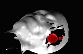 NASA Infrared Camera Helps Surgeons Map Brain Tumors